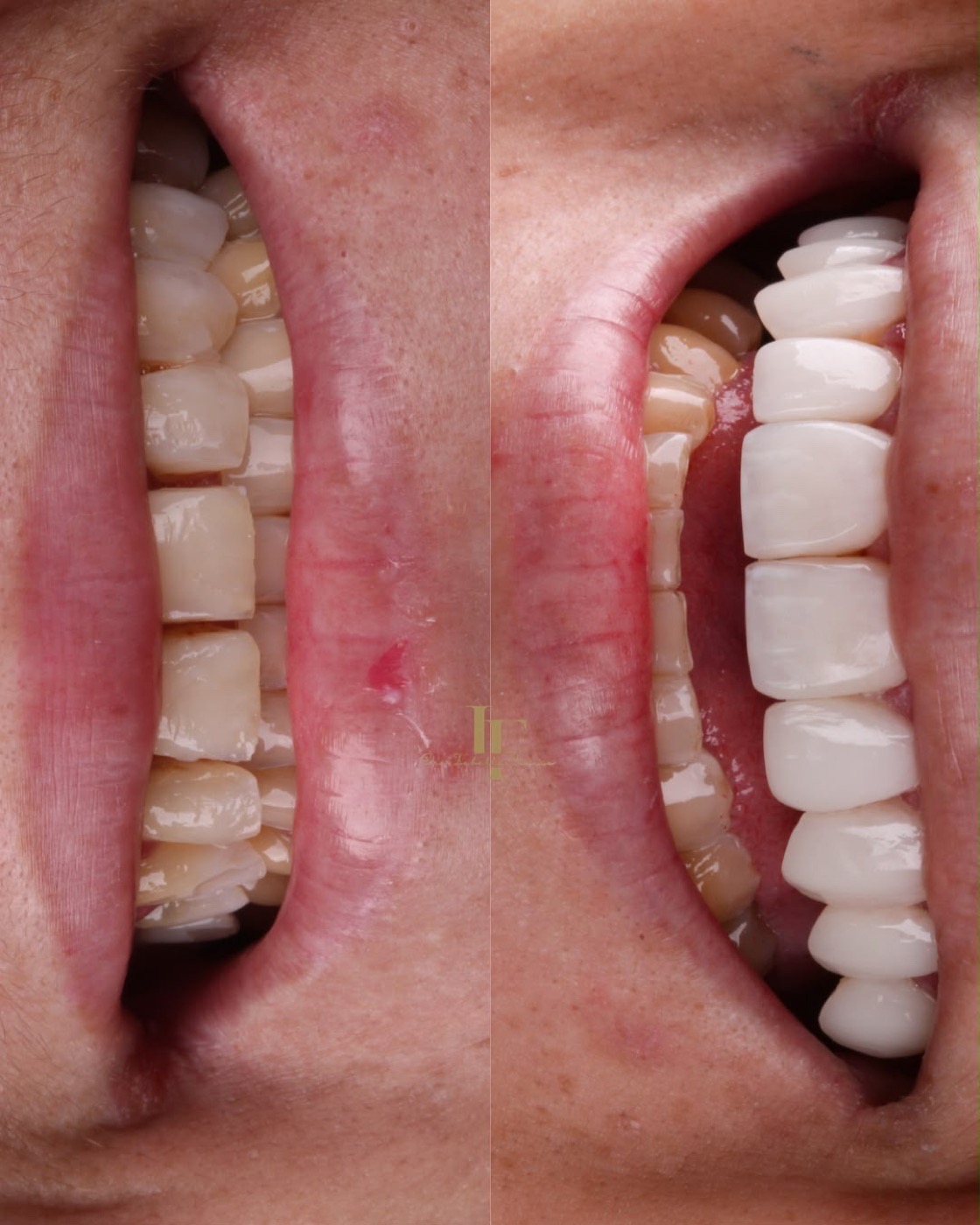 Comparativo clínico lateral do sorriso antes e depois do tratamento
